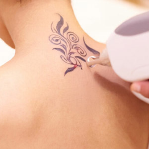 Estética Cattleya en Errenteria - Eliminación de tattoos